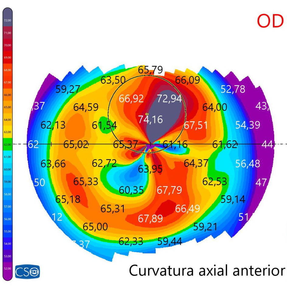 TOPOGRAFÍAS CORNEALES