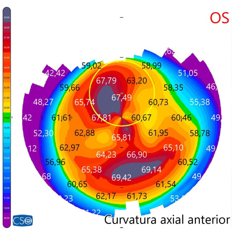 TOPOGRAFÍAS CORNEALES